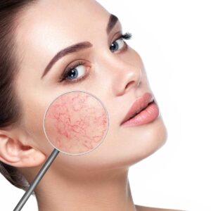 Laser Thread Vein Removal