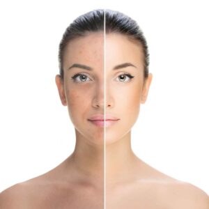 Laser Pigmentation Removal