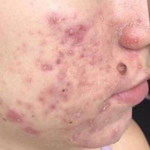 Blemiderm