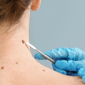 Map My Mole